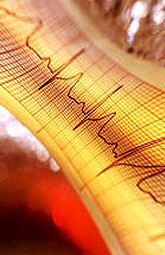 Fibrilación atrial mejora capacidad de ejercicio y calidad de vida