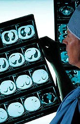 Descubren marcadores biológicos para diagnosticar la esquizofrenia