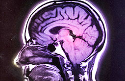 Accidentes cerebrales asintomáticos son habituales en la población sana