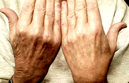 Psoriasis severa se relaciona con alto riesgo de muerte
