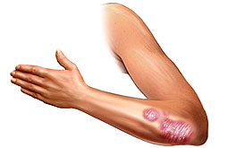Fármaco inmunosupresor reduce severidad de la psoriasis