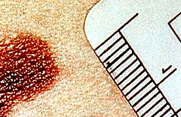 Criterios ABCDE mejoran la sensibilidad diagnóstica del melanoma cutáneo
