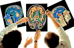 Factor VII reduce hematomas pero no mortalidad en la hemorragia intracerebral