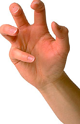 Vitamina D alivia los síntomas del lupus eritematos sistémico