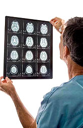 Alteración genética incrementa el accidente cerebrovascular