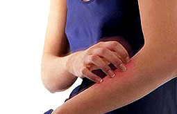 Psoriasis presenta más enfermedad cardiovascular y mortalidad
