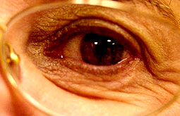 Enfermedad arterial periférica está relacionada con el glaucoma