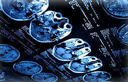 Incidencia de infartos lacunares provoca hipertensión arterial