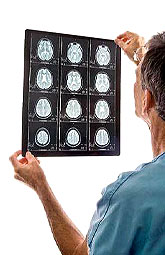 Herpes zóster agrava los accidentes cerebrovasculares