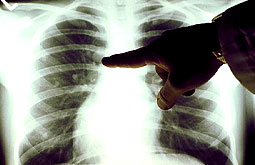 HMGB1 predice gravedad del cáncer pulmonar no microcítico