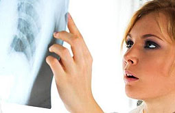 Dejar de fumar en el cáncer de pulmón mejora el pronóstico