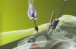 Crioablación laparoscópica es eficaz en el manejo oncológico renal