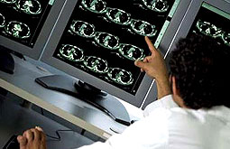 Altas dosis de vitamina D mejoran la inmunología de la esclerosis múltiple