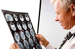 Filtración glomerular predice el peligro de accidente cerebrovascular