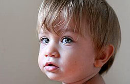 Propanolol modera los hemangiomas orbitarios infantiles