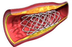 Hemorragia cerebral aumenta con el stent coronario
