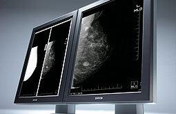 Densidad mamográfica está relacionada con el cáncer de mama