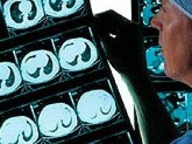 Descubren marcadores biológicos para diagnosticar la esquizofrenia