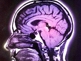 Accidentes cerebrales asintomáticos son habituales en la población sana
