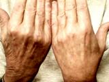 Psoriasis severa se relaciona con alto riesgo de muerte