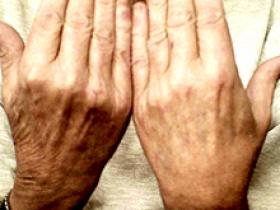Psoriasis severa se relaciona con alto riesgo de muerte