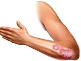 Fármaco inmunosupresor reduce severidad de la psoriasis