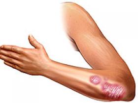 Fármaco inmunosupresor reduce severidad de la psoriasis