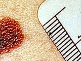 Criterios ABCDE mejoran la sensibilidad diagnóstica del melanoma cutáneo