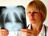 Hipovitaminosis D predispone a la aterosclerosis y enfermedad coronaria