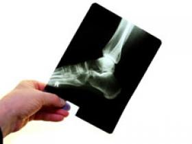 La vitamina C previene la gota