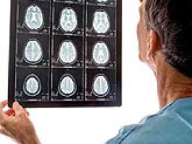 Alteración genética incrementa el accidente cerebrovascular
