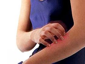Psoriasis presenta más enfermedad cardiovascular y mortalidad