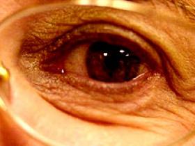 Enfermedad arterial periférica está relacionada con el glaucoma