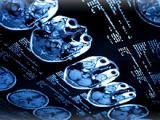 Incidencia de infartos lacunares provoca hipertensión arterial