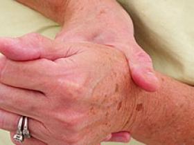 Infliximab mejora los síntomas clínicos de la artritis reumatoide