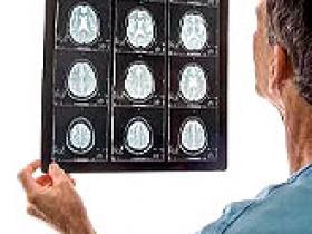 Herpes zóster agrava los accidentes cerebrovasculares