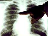 HMGB1 predice gravedad del cáncer pulmonar no microcítico