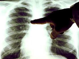 HMGB1 predice gravedad del cáncer pulmonar no microcítico
