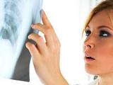 Dejar de fumar en el cáncer de pulmón mejora el pronóstico