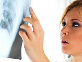 Dejar de fumar en el cáncer de pulmón mejora el pronóstico