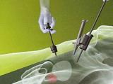 Crioablación laparoscópica es eficaz en el manejo oncológico renal
