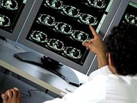 Altas dosis de vitamina D mejoran la inmunología de la esclerosis múltiple