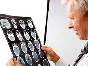 Filtración glomerular predice el peligro de accidente cerebrovascular