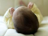 Propranolol es alternativa segura para los hemangiomas infantiles