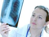 Sarcoidosis altera función vascular y estado inflamatorio