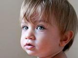 Propanolol modera los hemangiomas orbitarios infantiles