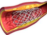 Hemorragia cerebral aumenta con el stent coronario