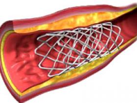 Hemorragia cerebral aumenta con el stent coronario