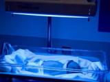 La fototerapia neonatal puede desarrollar lunares