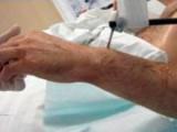 Incidencia de cáncer en pacientes trasplantados es más alta